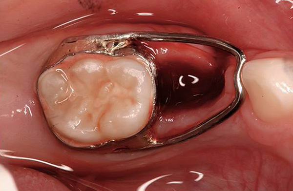 La foto muestra un ejemplo de un dispositivo que ahorra espacio en la dentición para la erupción de un diente permanente.