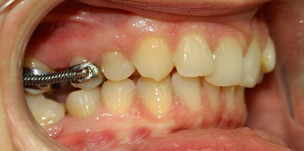 Al corregir la oclusión distal, un sistema de soporte especial con la ayuda de resortes ayuda a mover los dientes superiores 6 y 7 a la posición posterior.
