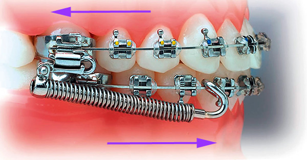 Una variación del dispositivo Gerbst: los resortes empujan la mandíbula inferior hacia adelante y el cambio hacia atrás.