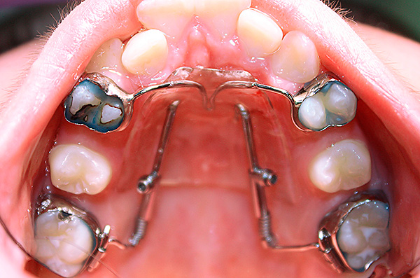 El dispositivo Distal Jet en la cavidad bucal del paciente.