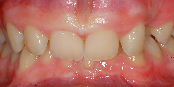 Derin distal oklüzyonla, kesici dişler genellikle yumuşak dokulara zarar verir - bir travmatik ısırık oluşur.