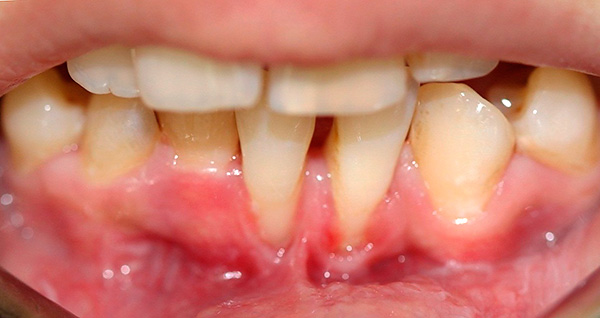 Alt kesici dişler alanında sakız durgunluğu.