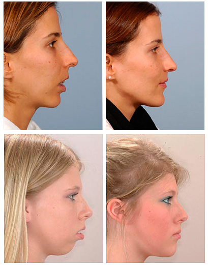 Fotoğraflar, yüz profilinin distal ısırığın düzeltilmesinden önce ve sonra nasıl göründüğünü gösterir.