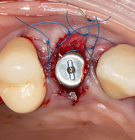 Teniendo en cuenta una cierta invasión del procedimiento, la hinchazón y el sangrado son realmente posibles después de que se instala el implante.