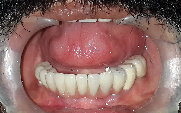 Một ví dụ về sự phục hồi của răng giả trên cấy ghép