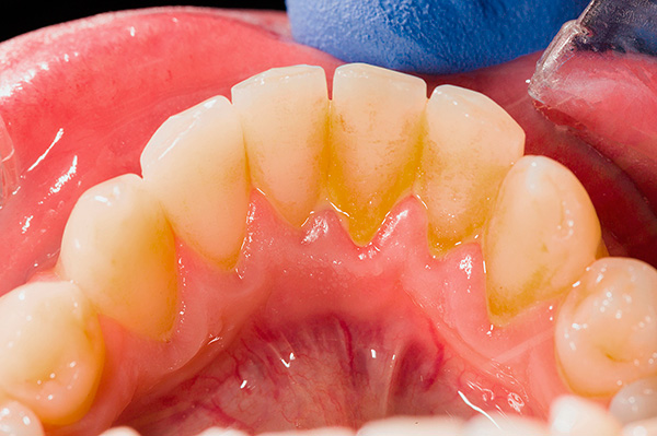 Schlechte Mundhygiene kann schnell zur Bildung von reichlich Plaque (Plaque und Zahnstein) führen.
