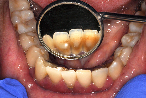 La acumulación de placa y piedra en el futuro puede conducir a periodontitis y movilidad no solo de los dientes nativos, sino también de los implantes.