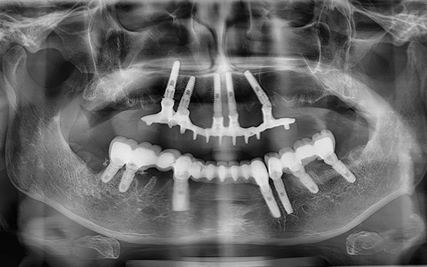 En casos raros, un implante puede dañar la pared del seno maxilar.