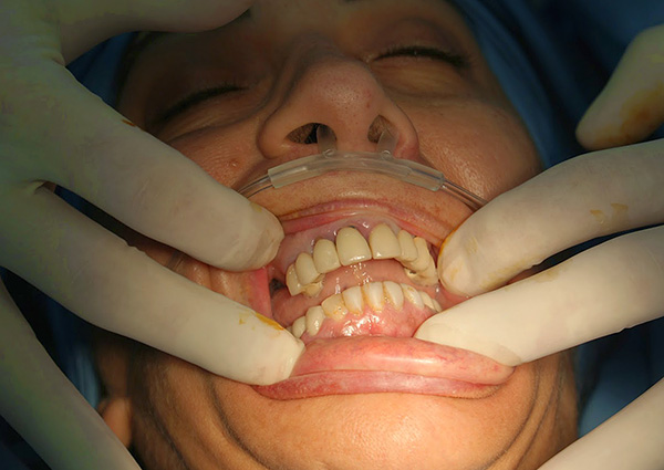 En algunos casos, los implantes se pueden instalar con anestesia general (anestesia).