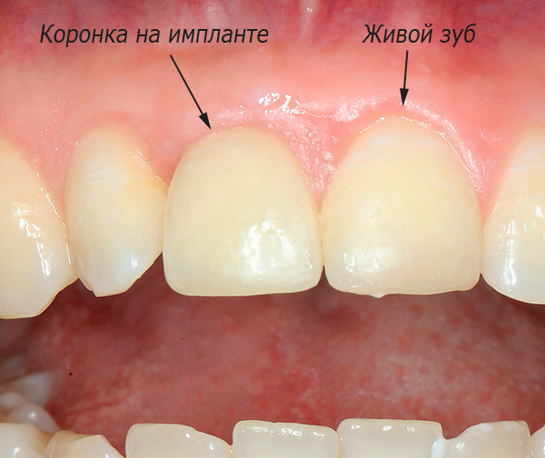 En esta foto puede ver el resultado de las prótesis del diente frontal en el implante XiVE.