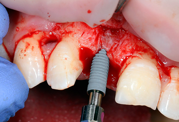 La foto muestra la instalación del implante XiVE en la mandíbula ...