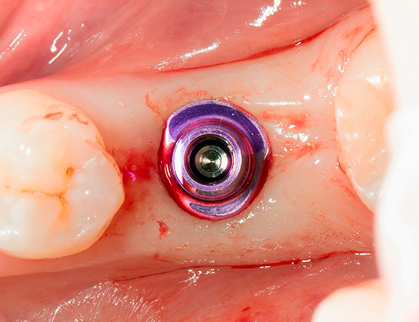 La foto muestra el implante XiVE colocado en la mandíbula.