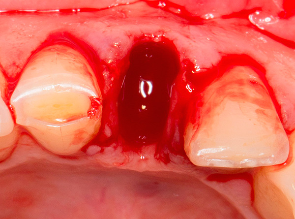 En algunos casos, con el uso de implantes XiVE, es posible realizar el llamado implante inmediato, al instalarlos en el orificio del diente recién extraído.