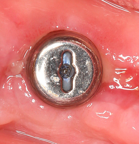Un ejemplo de un implante bien establecido (un formador de goma se instala afuera).