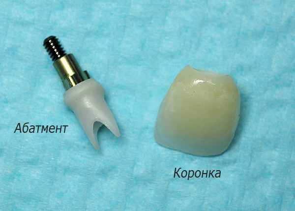 Una contribución significativa al costo total de las prótesis sobre implantes se realiza mediante un pilar permanente y una corona.