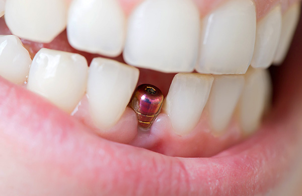 Hablemos sobre cuánto puede durar un implante dental en promedio, y qué factores a veces afectan este período ...
