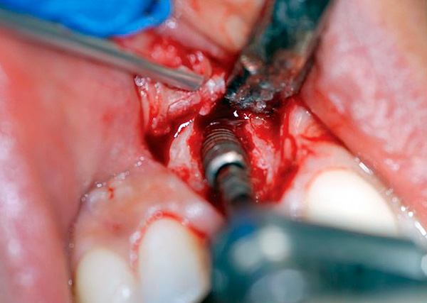 Extracción de un implante dental de la mandíbula ...