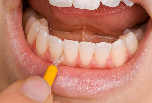 En lugar de un hilo dental, es útil utilizar cepillos interdentales.