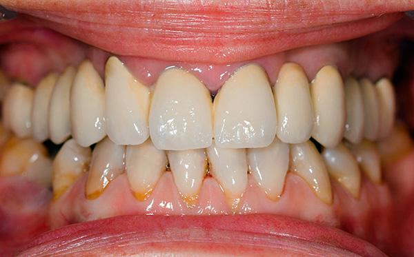 Si no presta suficiente atención a la higiene bucal, la vida útil de los implantes dentales puede ser muy pequeña.
