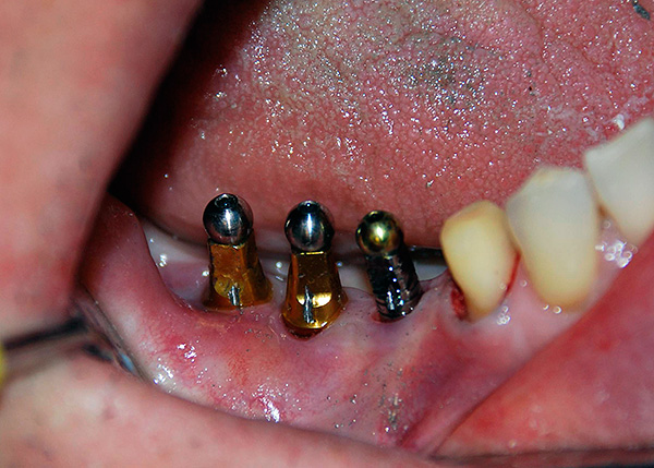 La vida útil de los implantes dentales más caros y de calidad puede ser muy pequeña, si el médico comete errores al instalarlos ...