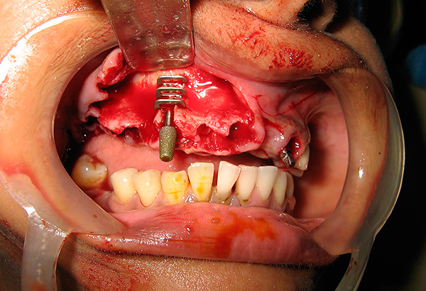 La foto muestra un ejemplo de instalación de un implante basal de diseño obsoleto.