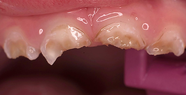 Sin el cuidado bucal adecuado, la situación con los dientes de leche puede convertirse rápidamente en catastrófica ...
