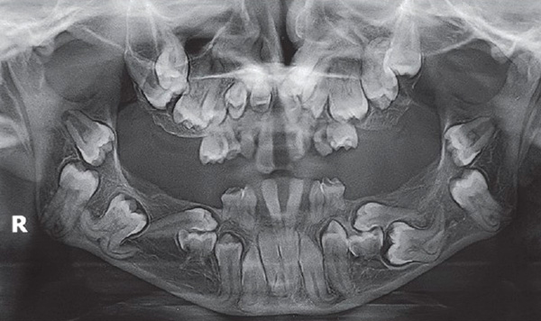 Diş mikroplarının anormal konumu, bir X-ışını kullanılarak önceden tanımlanabilir.