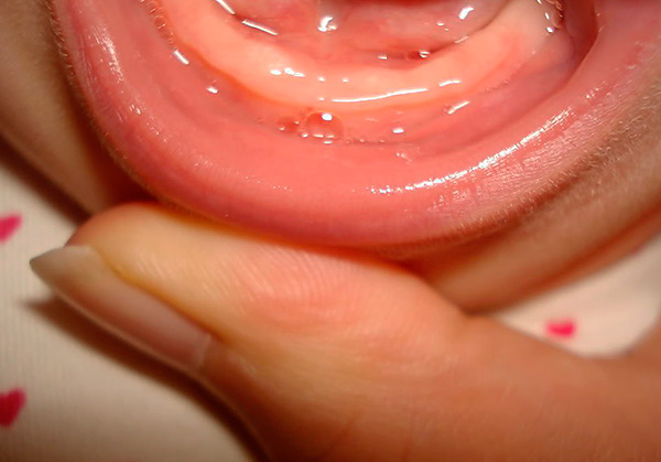 Τα ούλα ενός παιδιού ηλικίας έως περίπου 4-6 μηνών συνήθως αποκλείονται από τα δόντια.