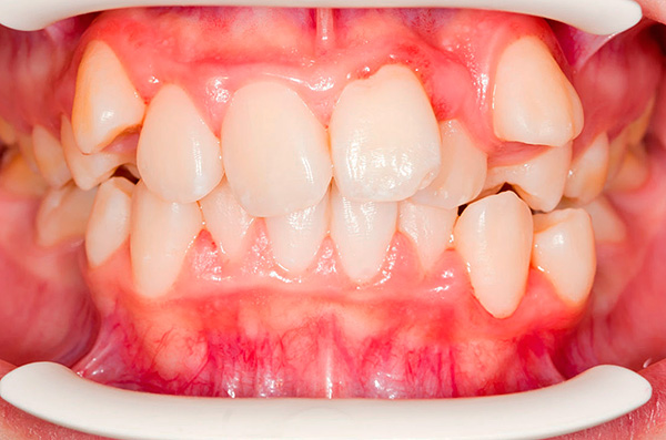 Distopía de dientes (su ubicación no se encuentra en su lugar normal).