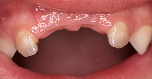 La pérdida prematura de los dientes de leche puede afectar negativamente el desarrollo de una mordida permanente en el niño.