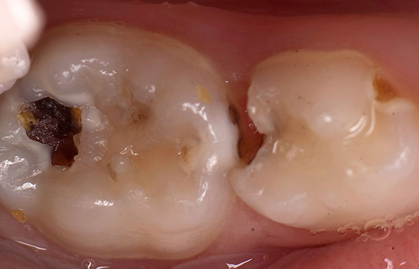En caso de pérdida prematura del diente de masticación, pueden producirse cambios negativos en la posición del diente adyacente, así como el antagonista en la mandíbula opuesta.