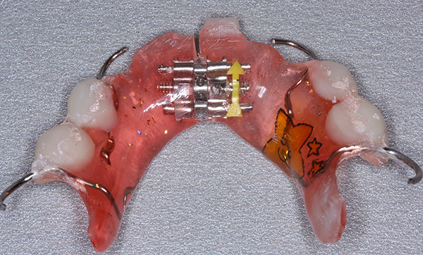 Συσκευή με επεκτατική βίδα και τεχνητά δόντια για τη διόρθωση του δαγκώματος του γάλακτος.