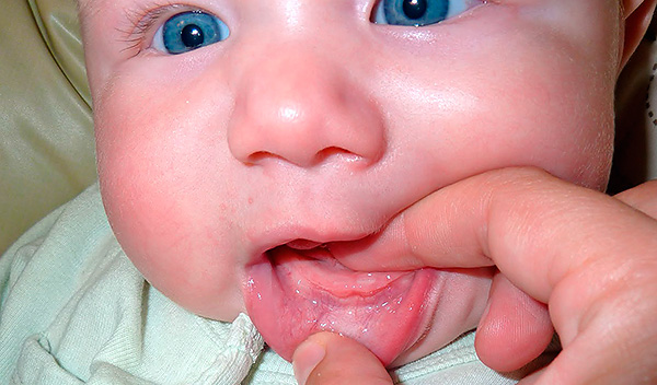 Genellikle ilk kesici dişler patlar - bu sırada bebek kaprisli hale gelebilir, bazen vücut ısısı yükselir.