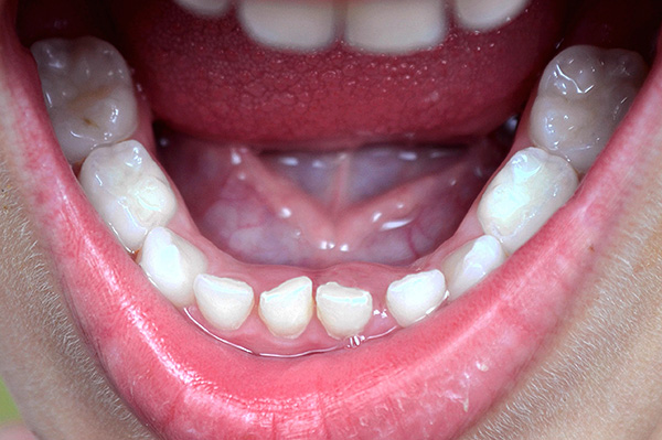 En la mordida completa de leche en la mandíbula inferior hay 10 dientes (y el mismo número en la mandíbula superior).
