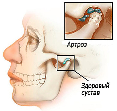 La imagen muestra esquemáticamente la artrosis de la articulación temporomandibular ...