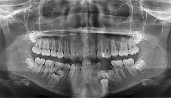 Ortopantomogram, çeşitli lokma anormalliklerinin teşhis edilmesinde ortodontiste yardımcı olur.