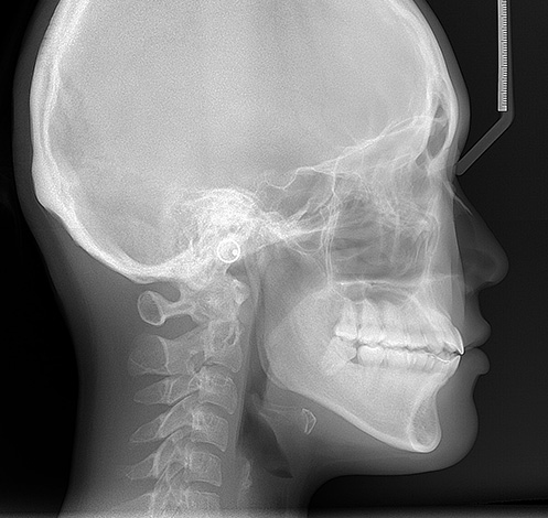 Teleografía de rayos X del cráneo.