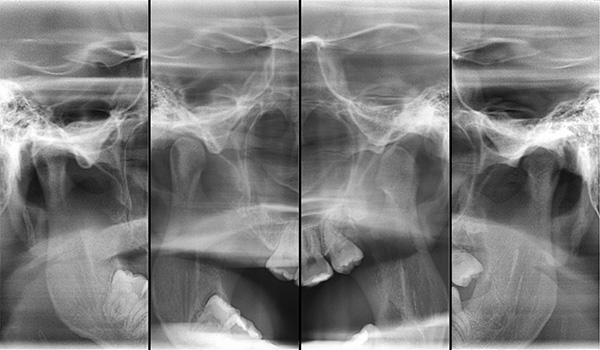 Radiografía de la articulación temporomandibular.