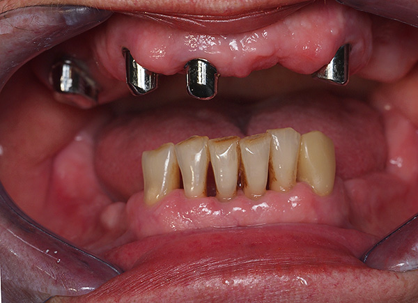 Situación clínica antes de las prótesis: se instalan coronas de metal en los dientes preservados de la mandíbula superior.