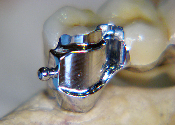자물쇠 부분은 치아에 장착 된 크라운에 있습니다.