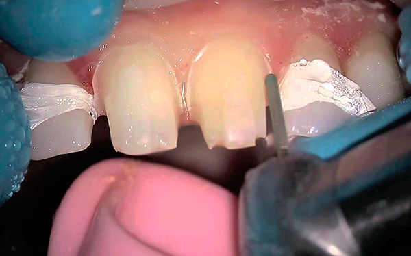 Un inconveniente importante de la prótesis de cierre en las cerraduras es la necesidad de girar los dientes pilares debajo de las coronas.