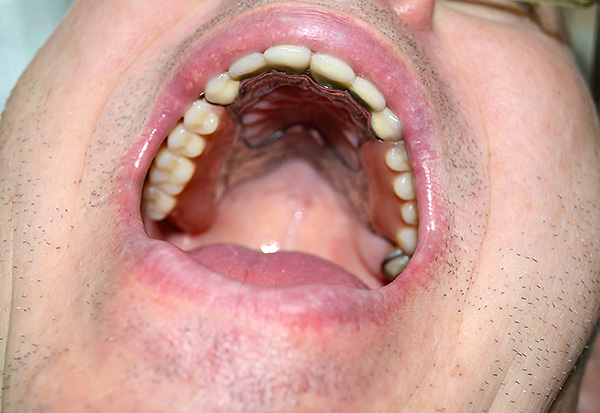 Como puede ver, la prótesis de cierre en la cavidad oral se ve bastante limpia, y esta no es su única ventaja.