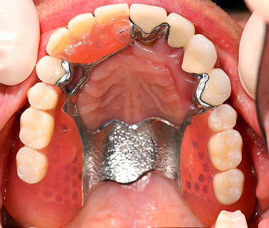 Un exemple de prothèse dentaire montée sur la mâchoire supérieure.