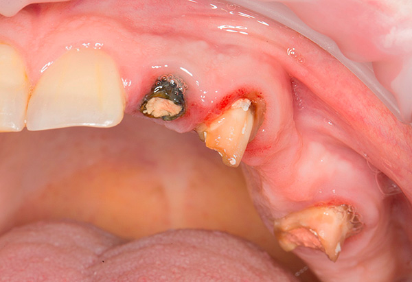 Es posible que sea necesario extraer algunos dientes (o sus restos) antes del procedimiento de prótesis.