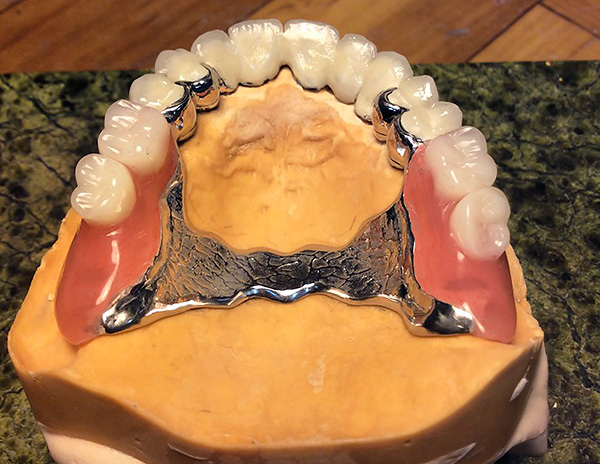 La foto muestra un ejemplo de una prótesis parcial terminada instalada en el modelo de maxilar superior del paciente.