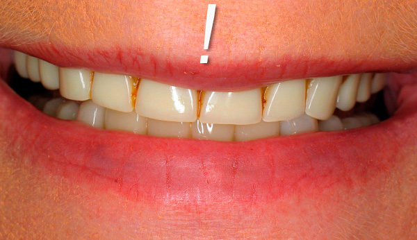 Điều quan trọng cần lưu ý là răng giả nên được duy trì thường xuyên, vì mảng bám cũng có thể tích tụ trên răng.