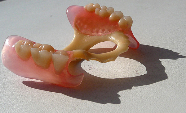 Ví dụ về hàm răng giả một phần Quadrotti (Quattro Ti)