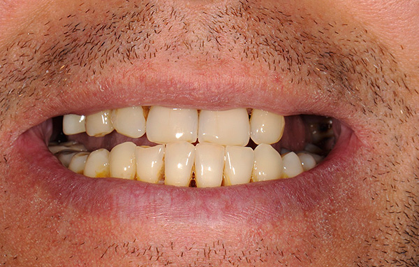 Dişlerin çok sayıda kusuru (özellikle son olanlar), kısmi takma dişlerin takılması için endikasyonlardan biridir.