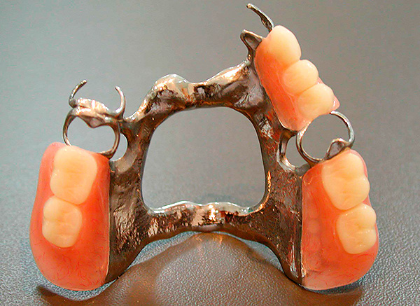 Trong trường hợp hiếm hoi, các thành phần nhựa và kim loại của bộ phận giả có thể gây ra phản ứng dị ứng từ niêm mạc miệng.