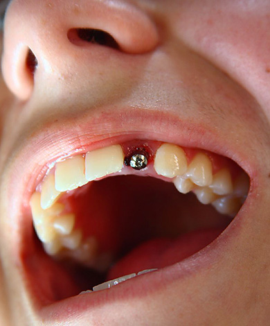 La foto muestra un ejemplo de la instalación de un implante Alpha BIO en un área estéticamente significativa con la pérdida de un diente.